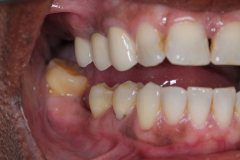 Dentures - Case 1
