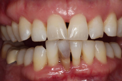 Dentures - Case 2