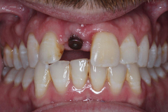 Front-tooth-implant