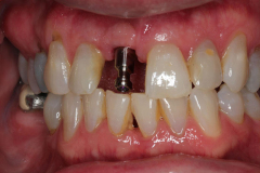 Front-implant