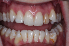 Single Tooth Treatment - Case 1