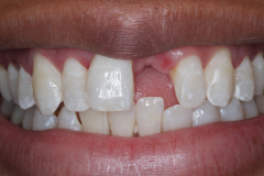 Single Tooth Treatment - Case 11