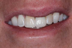 Single Tooth Treatment - Case 2