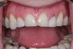 Single Tooth Treatment - Case 4