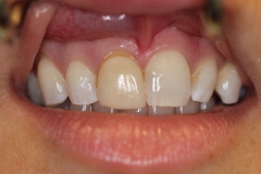 Single Tooth Treatment - Case 5