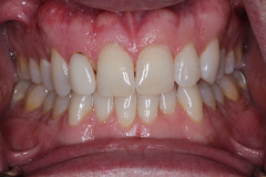 Single Tooth Treatment - Case 6