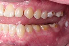 Worn Teeth and Acid Erosion - Example 1