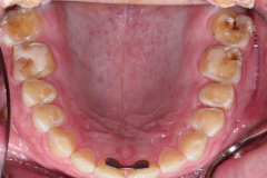 Upper-teeth