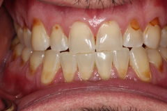 Worn Teeth and Acid Erosion - Example 2