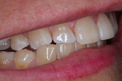 Worn Teeth and Acid Erosion - Example 3