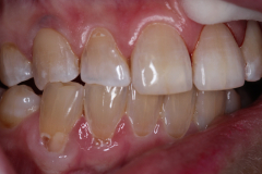 Teeth-Grinding