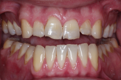 Front-teeth
