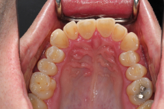Upper-teeth