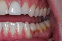 Worn Teeth and Acid Erosion - Example 5
