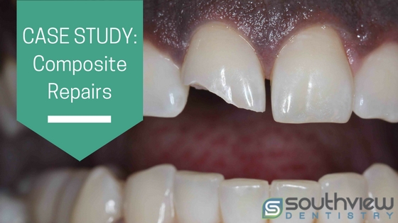 Case Study: Composite Front Teeth Repairs