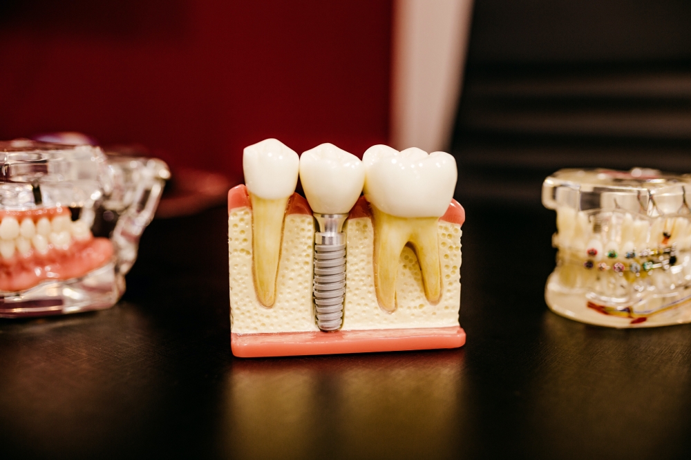 What-Are-Dental-Implants-and-How-Do-They-Work