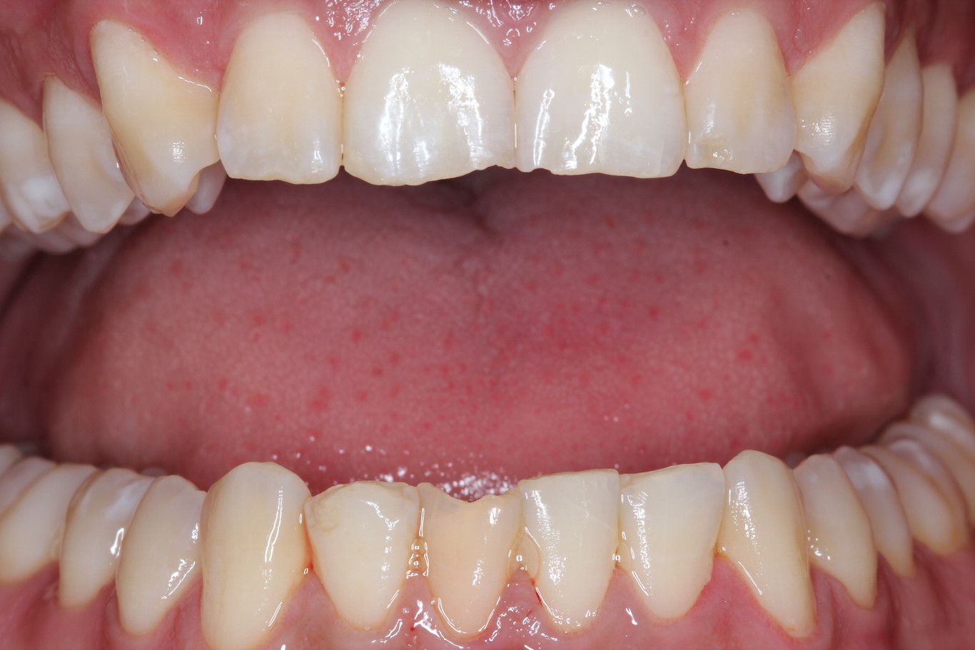 pinhole procedure for receding gums