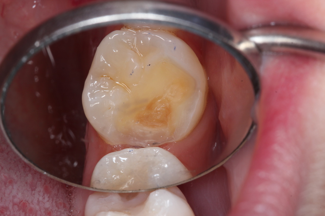 Southview Porcelain Onlay Case Study- Before- Cavity_Breakage