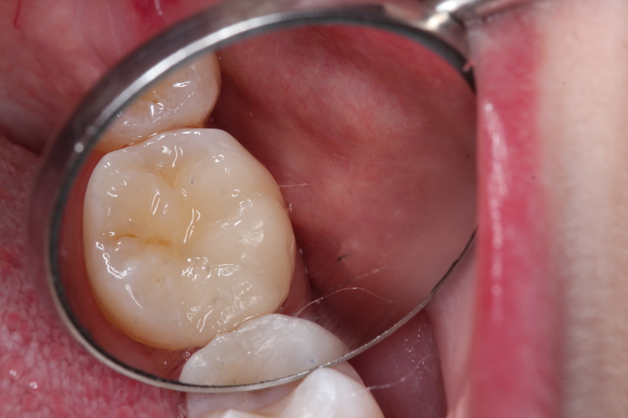 Southview Porcelain Onlays for Teeth Case Study- After- onlay placed
