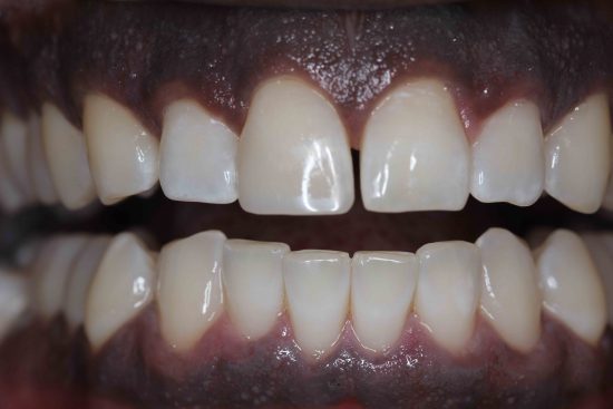 front tooth chip repair