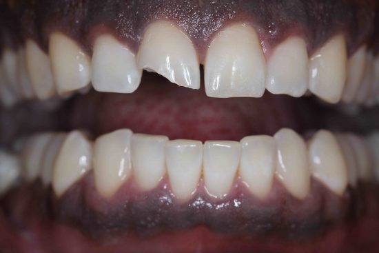 front tooth chip repair