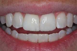 internal teeth whitening after