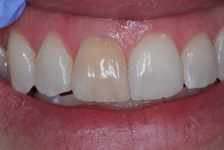 internal tooth whitening before