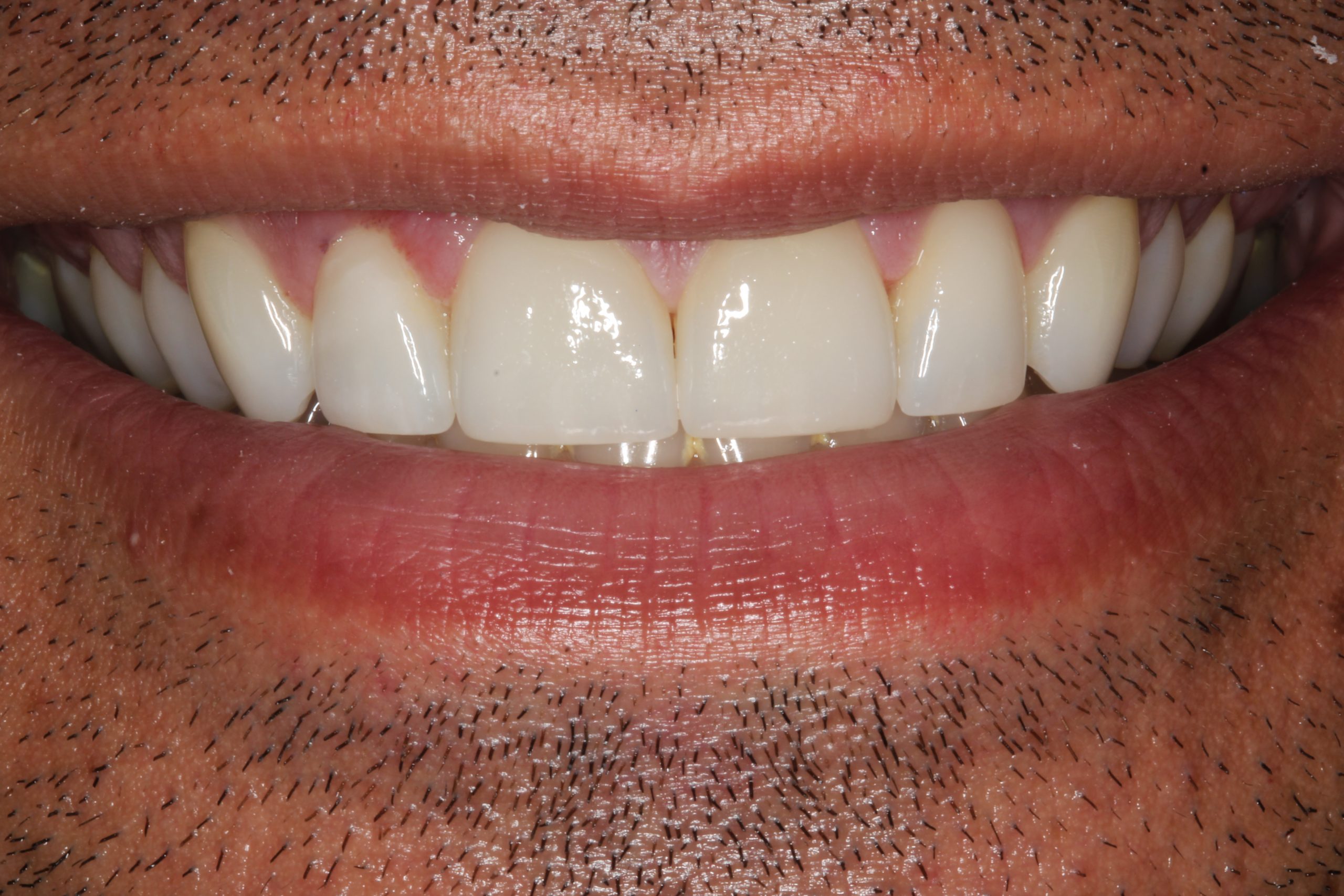 veneers to close gap in front teeth
