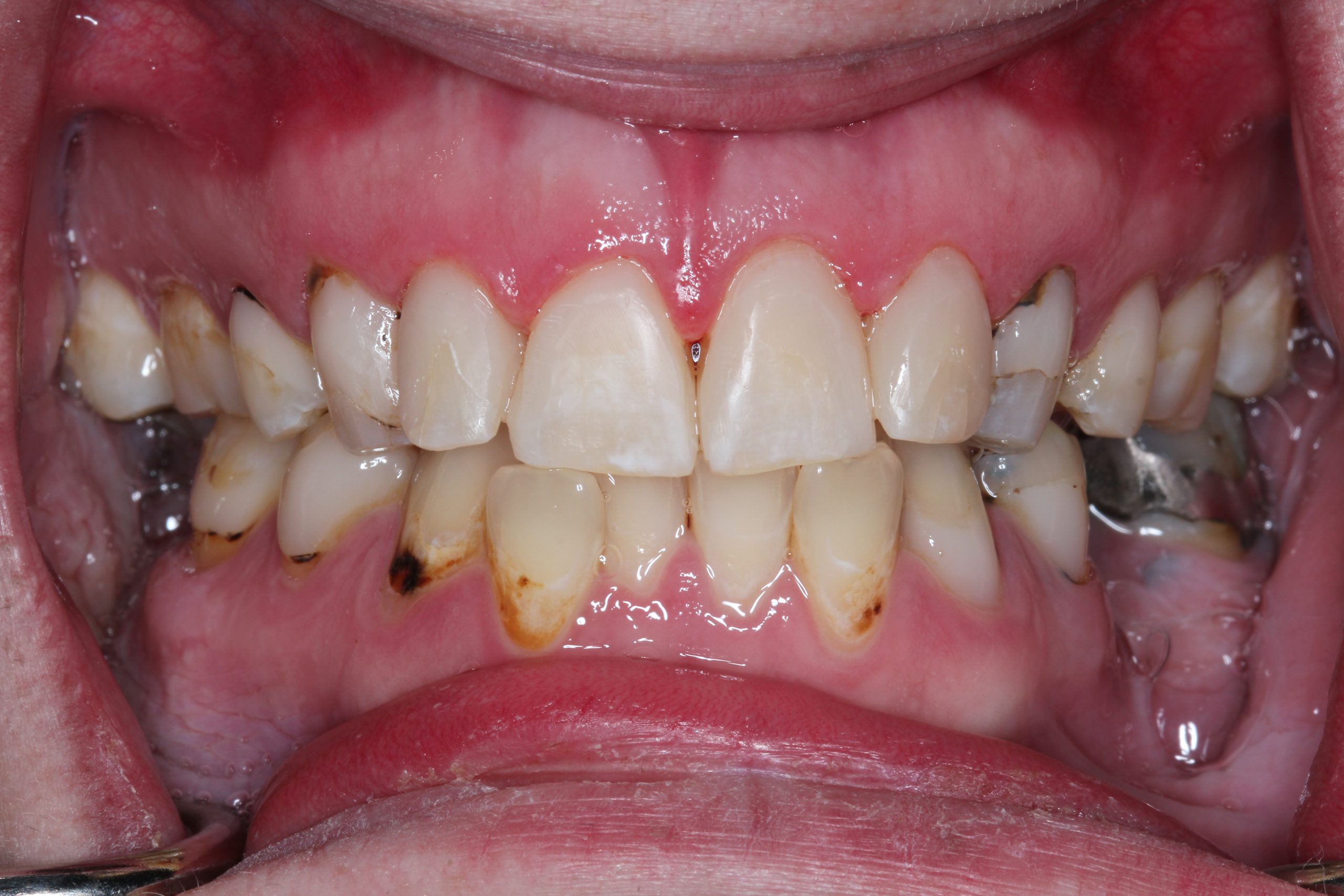 acid erosion on teeth case study