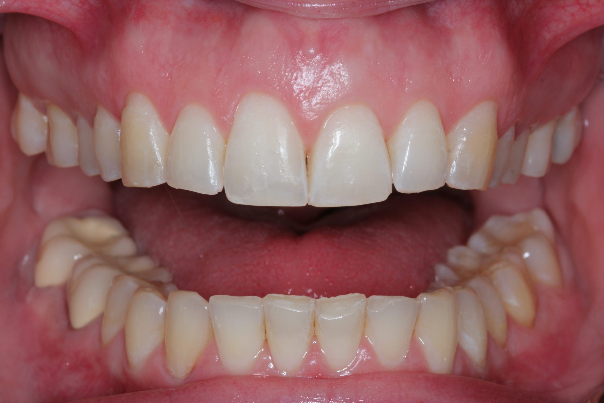 Invisalign treatment before after