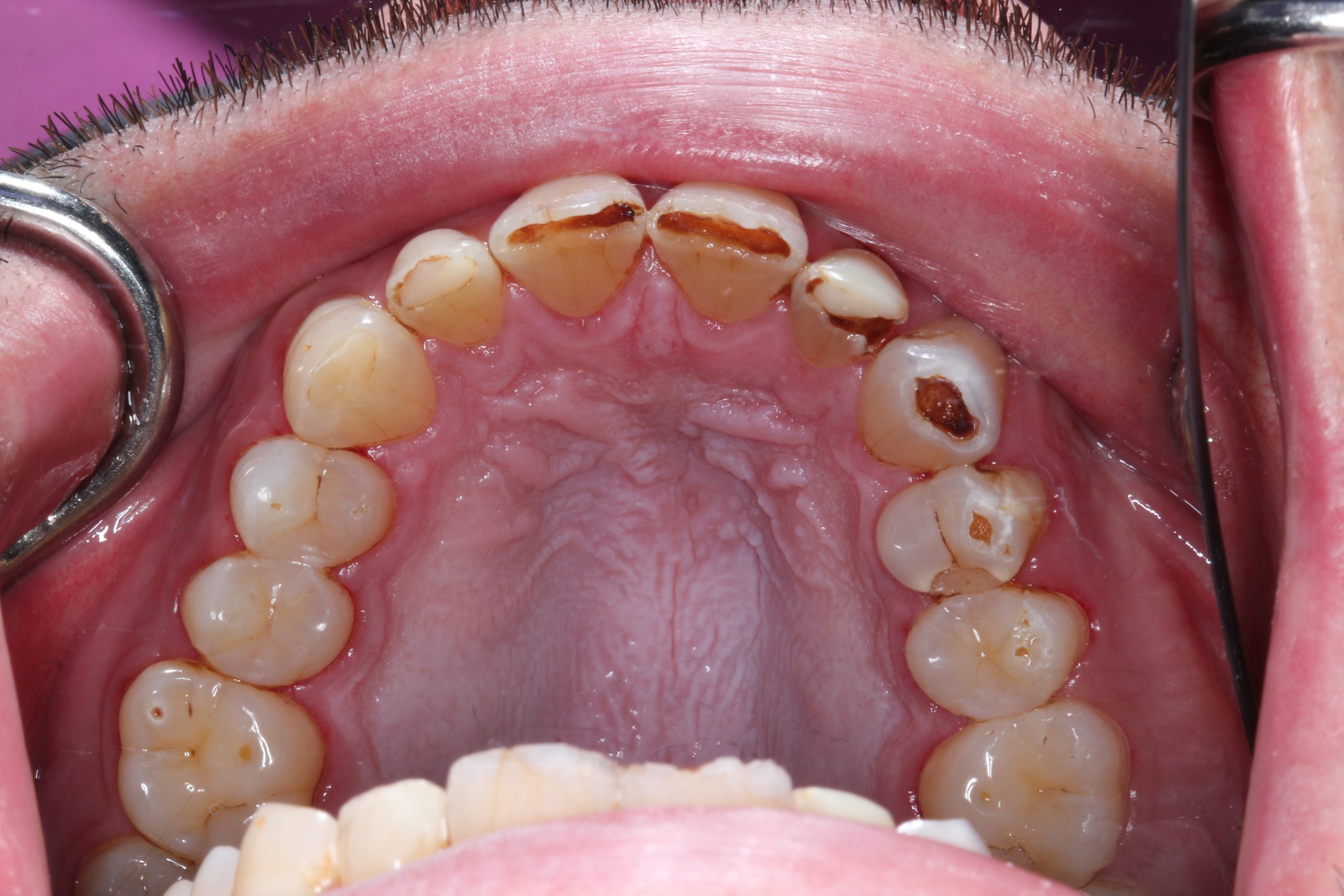 acid erosion on teeth case study photo