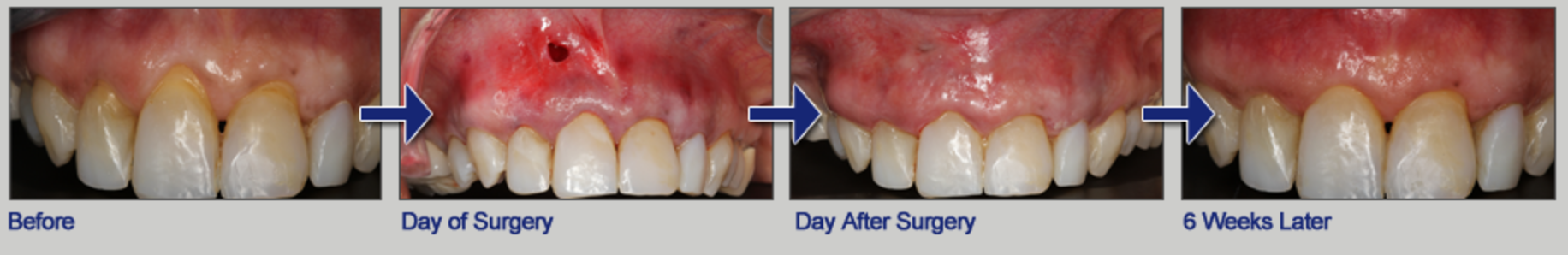 Pinhole gum rejuvenation procedure before and after