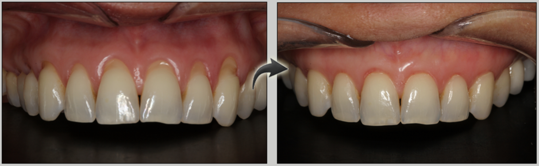 Dr. Chao Pinhole Surgical Gum RejuvenationTechnique before and after