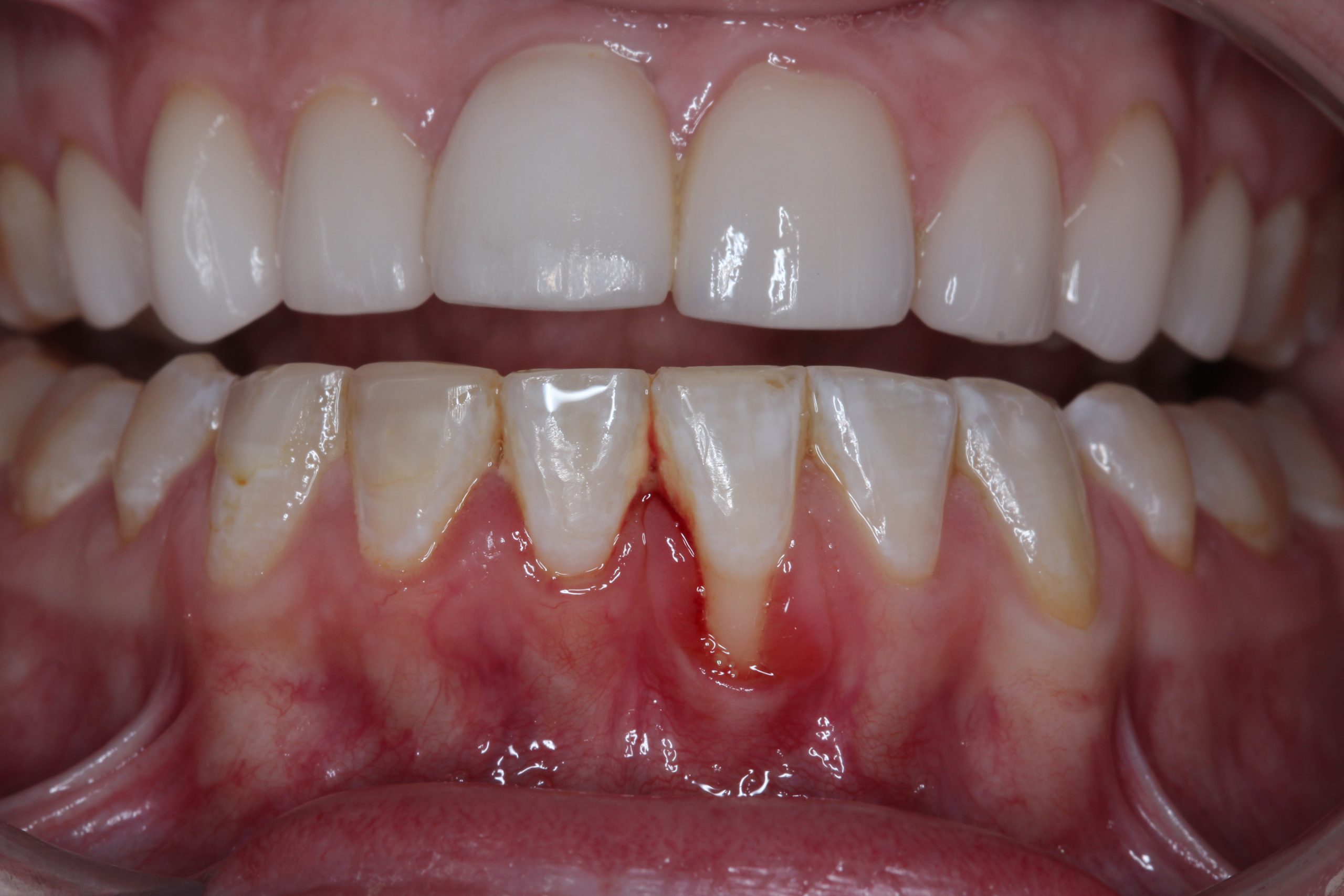 how to fix gum recession before