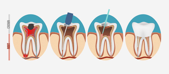 root-canal-charlotte-nc-image