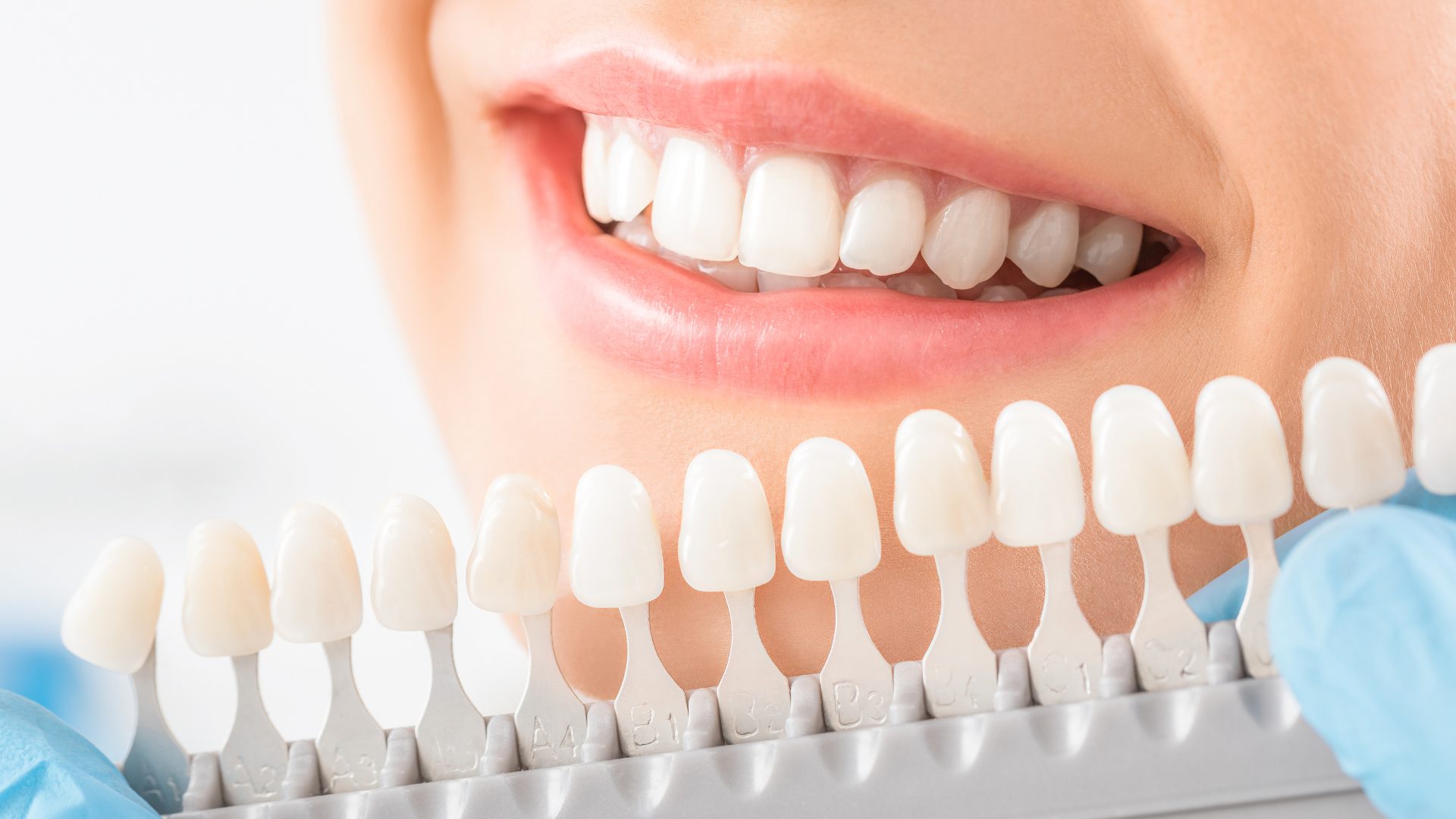 how to keep your smile makeover
