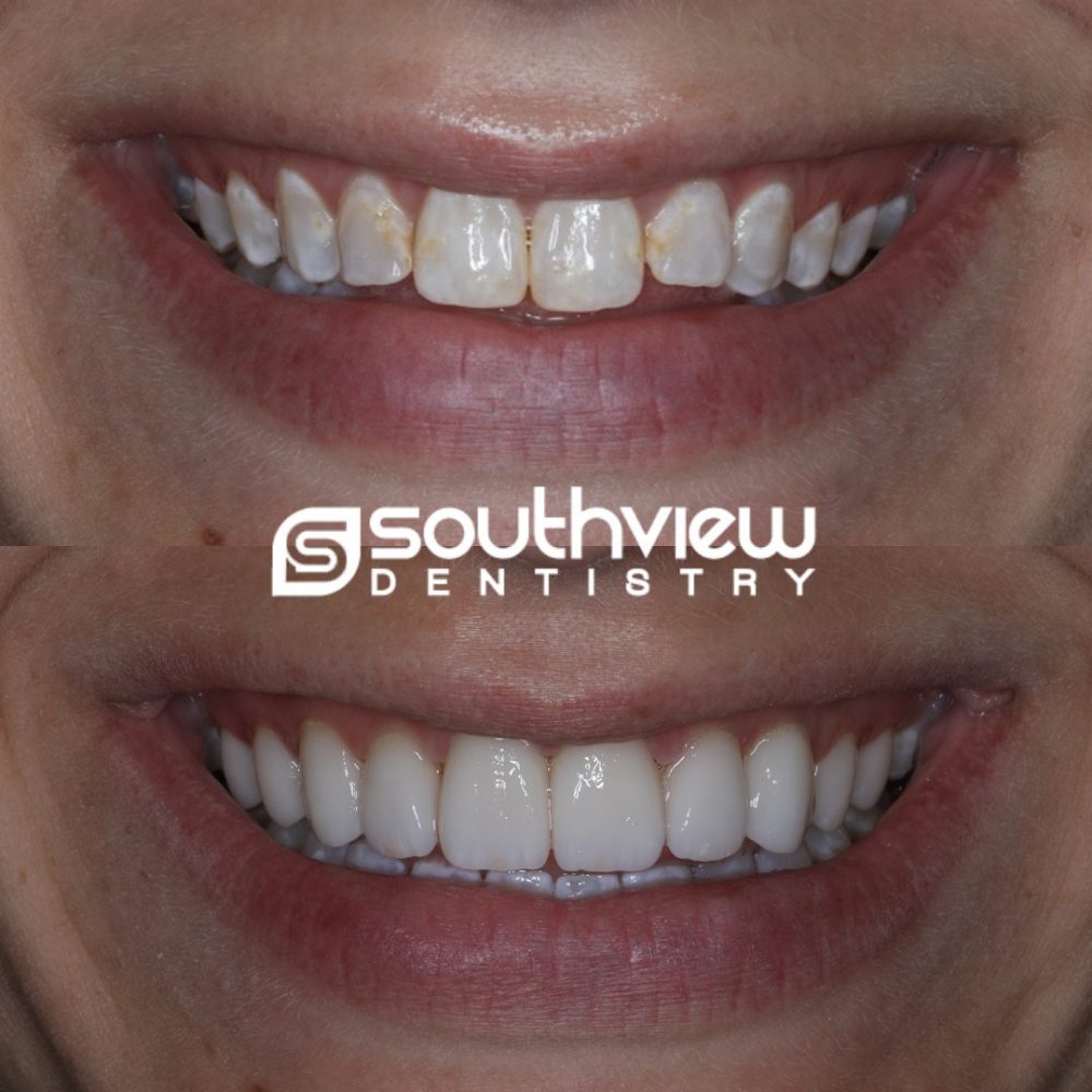 veneers faq