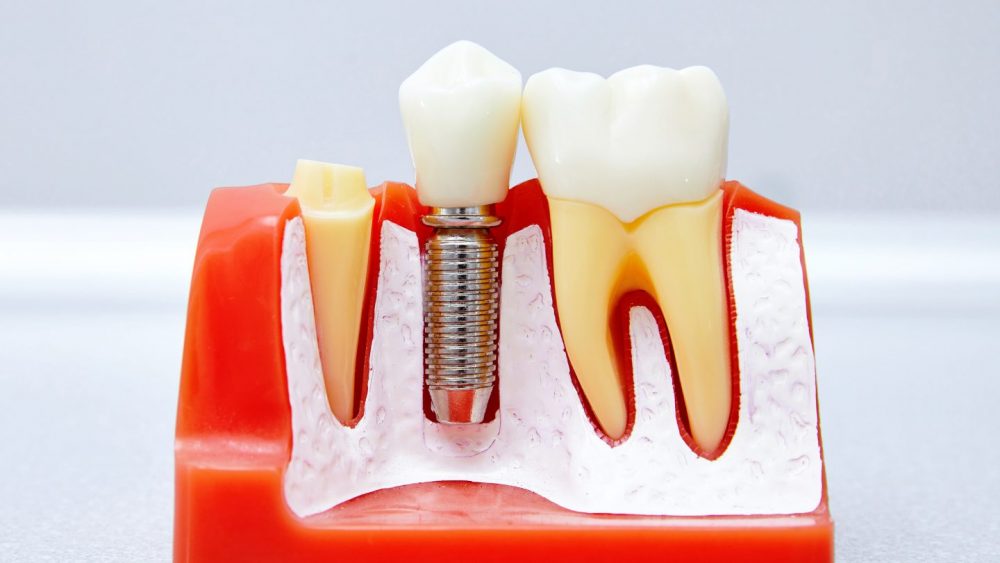 dental tooth implant