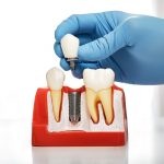 dental implants vs. bridges